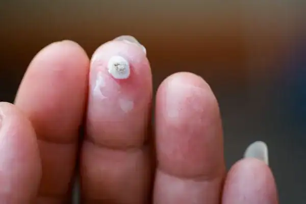 Image of white wart before cryopen treatment Northwood