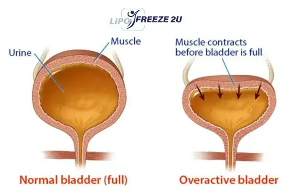 diagram of overactive bladder treatment Northwood