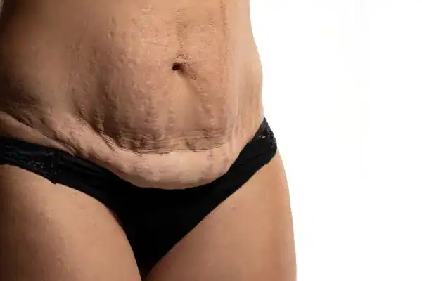 loose skin after weight loss injections Northwood