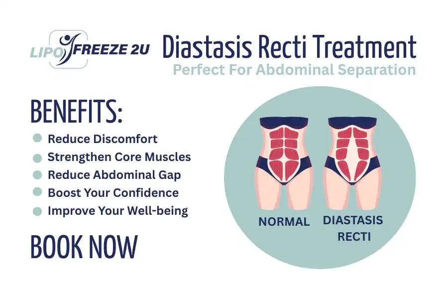 How Long Will It Take to See Improvements in Diastasis Recti Northwood