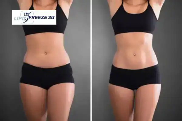 How Can LIPO FREEZE 2U Support Your Post-Pregnancy Body Recovery Northwood?