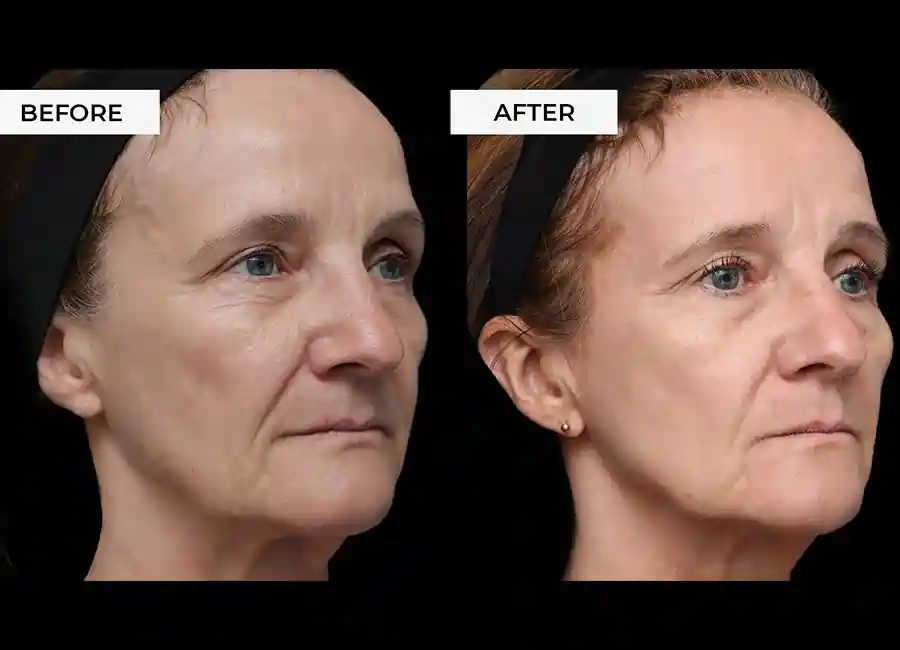 How Many RF Microneedling Sessions Will You Need to See a Difference Northwood?