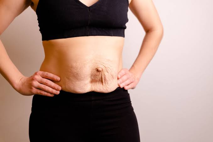 Is Surgery Really the Only Way to Repair Diastasis Recti Northwood?